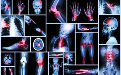 Schmerzzustände in Röntgenbildern