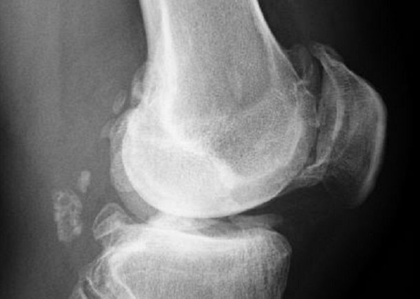 Röntgenaufnahme Kniegelenk
