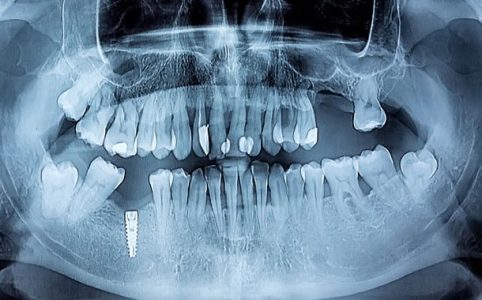 Panorama-Röntgenbild Zähne inkl. toter Zähne