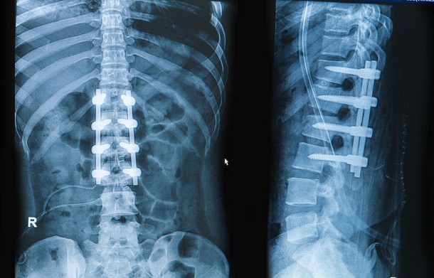 Röntgenbild Wirbelversteifung - Spondylodese